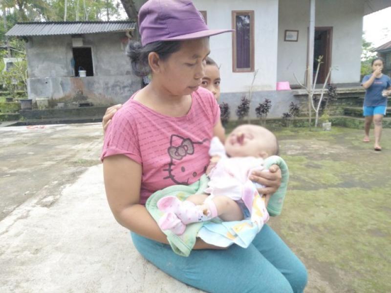 hydrocephalus